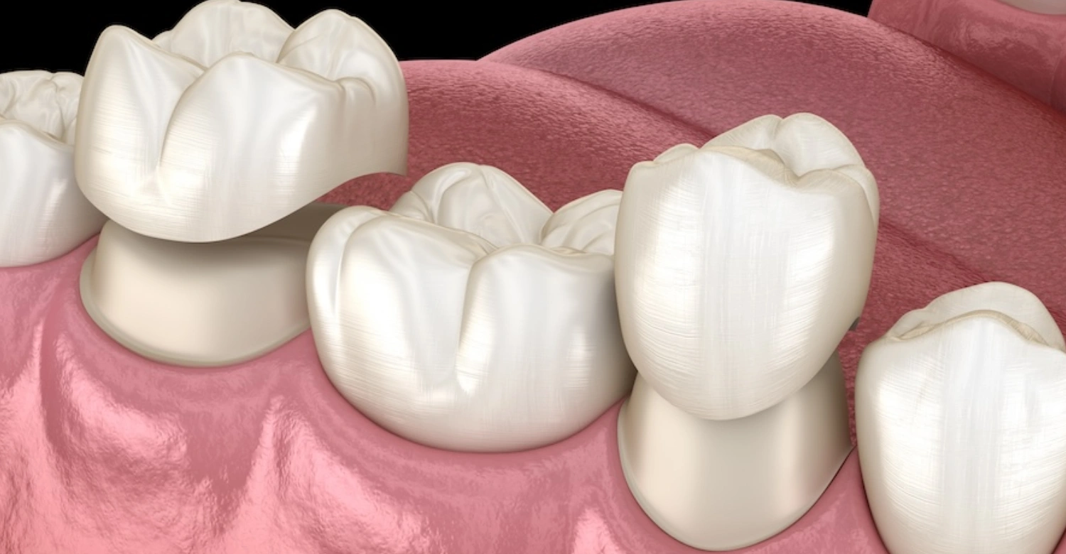 Dental Crown Lifespan Inblog